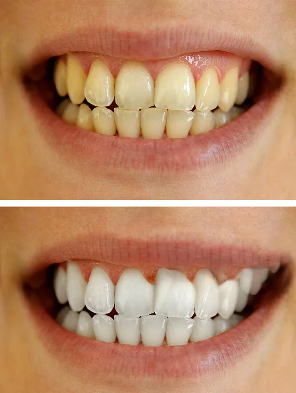 smoke-weed-without-staining-teeth smoke-weed-without-staining-teeth