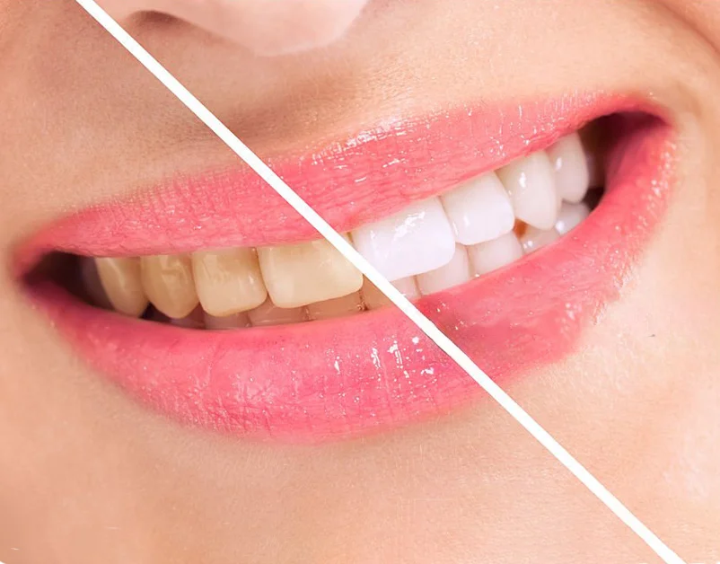 how-to-get-rid-of-weed-stains-on-teeth how-to-get-rid-of-weed-stains-on-teeth